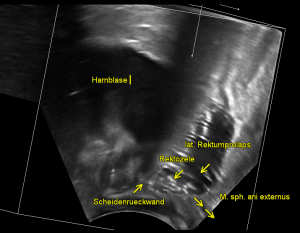 Perineal Sonographi